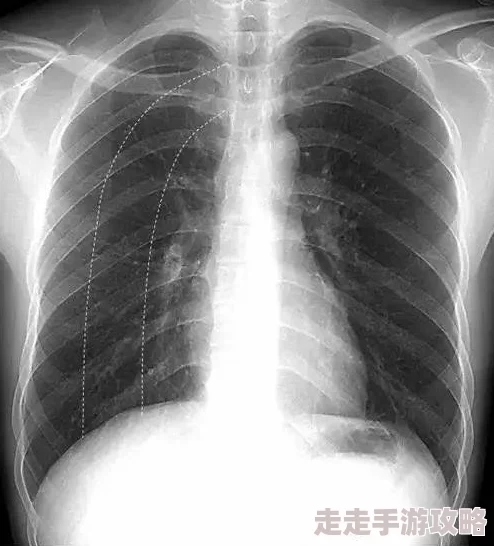 胸片全体曝光：最新研究揭示肺部健康与生活方式之间的密切关系，影响深远引发广泛关注